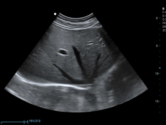 Mobilny aparat USG Zoncare M70 z głowicą liniową