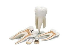 Model dentystyczny zęba trzonowego z próchnicą D15