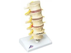 Model zwyrodnienia kręgów z przepukliną kręgów A795