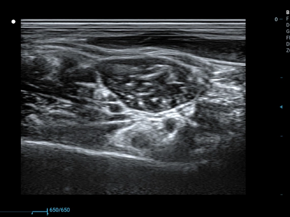 Mobilny aparat USG Zoncare M70 z głowicą liniową i convex
