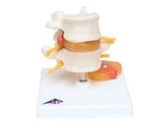 Model kręgów lędźwiowych z wypadnięciem jądra galaretowatego A76