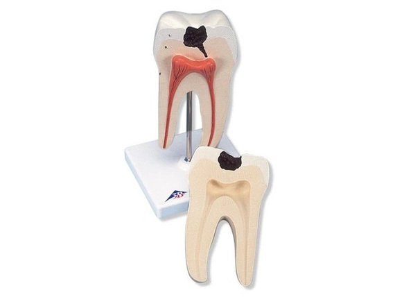 Model dolnego zęba trzonowego z próchnicą D10/4