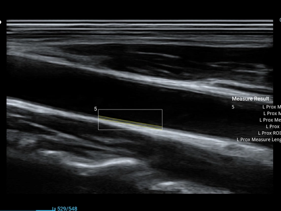 Mobilny aparat USG Zoncare M70 z głowicą convex