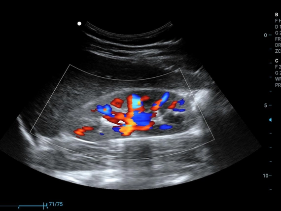 Mobilny aparat USG Zoncare M70 z głowicą liniową i convex