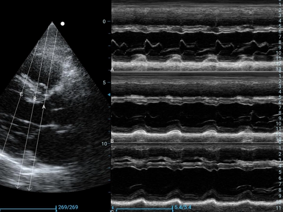 Mobilny aparat USG Zoncare M70 z głowicą convex