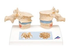 Model osteoporozy A95